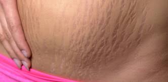 strech marks in nigeria