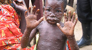 What to know about and Avoid in Monkey Pox Infection