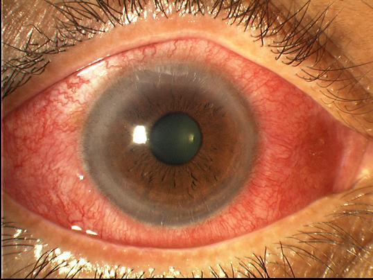 Eye problem
